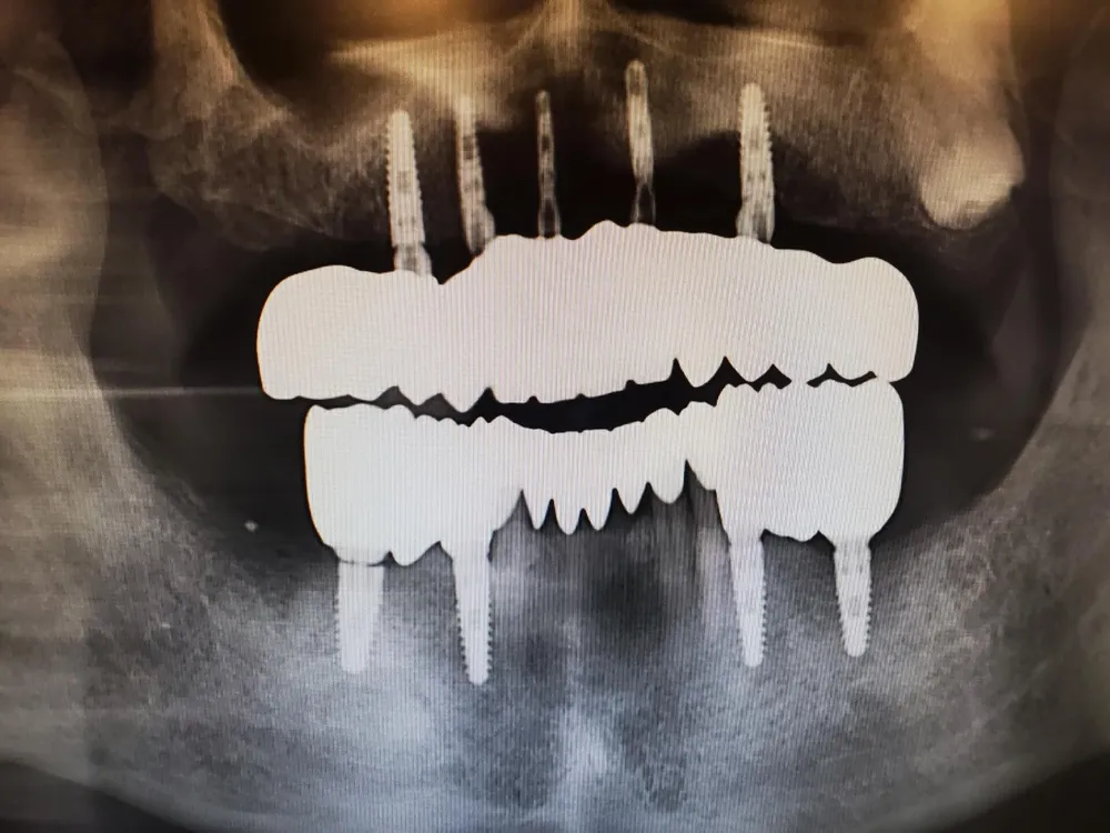 All-on-X full-arch implant case