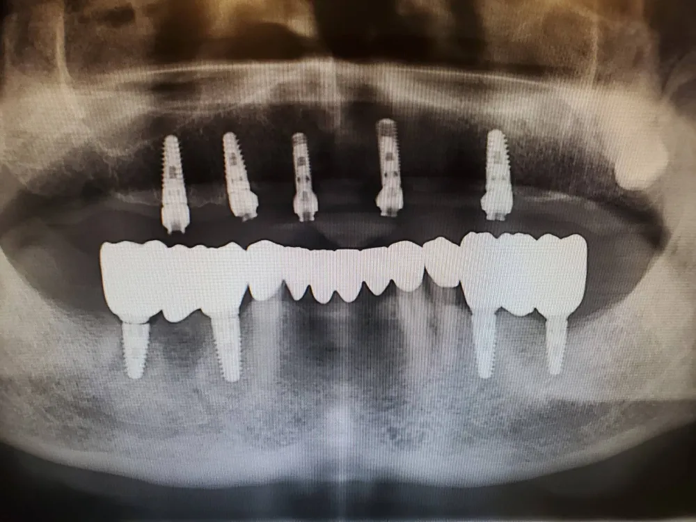 Dental implant restoration case