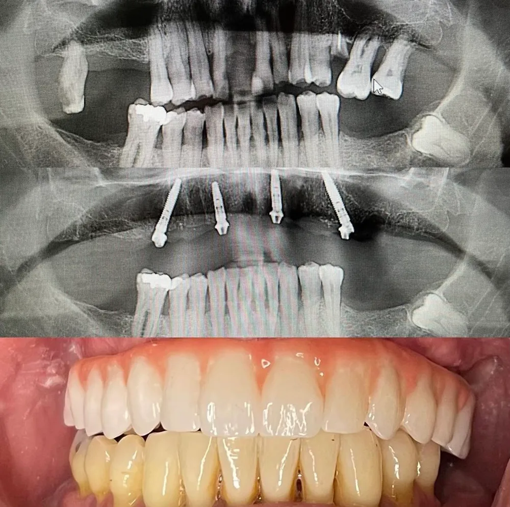 All-on-X full-arch implant result at Terrell Hills Dental