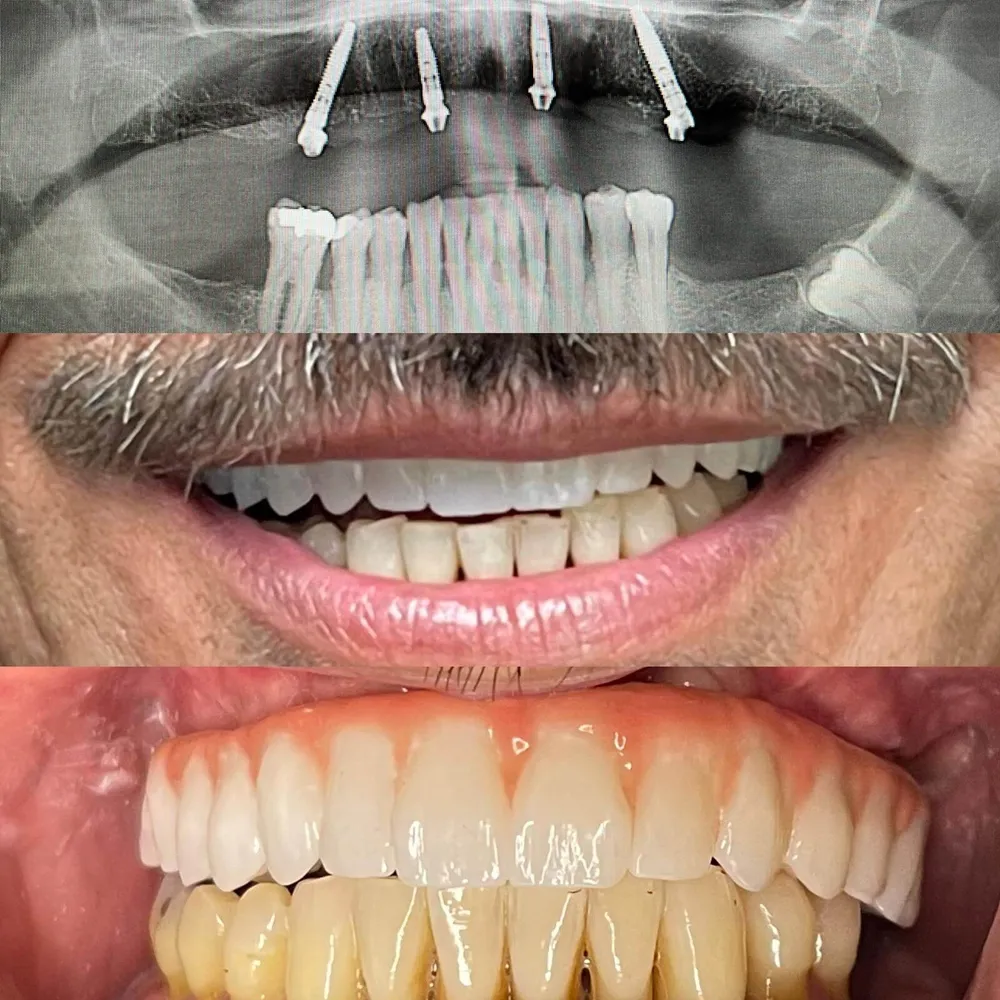 All-on-X implant smile result
