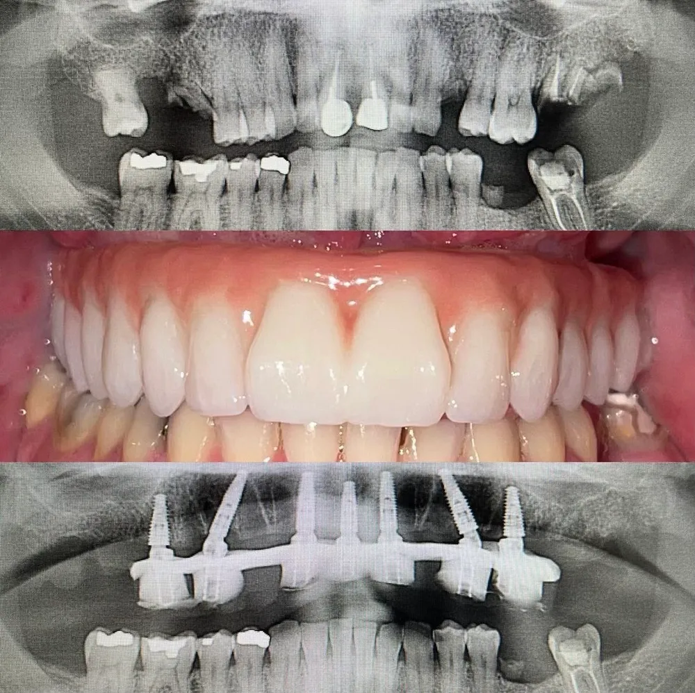 Full-arch implant result