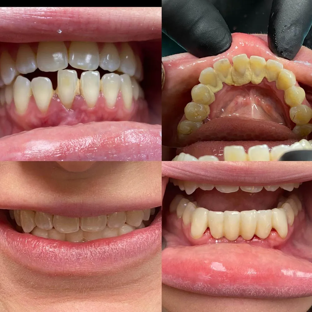 Implant-supported bridge case
