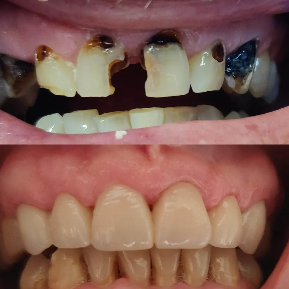 Implant crown restoration