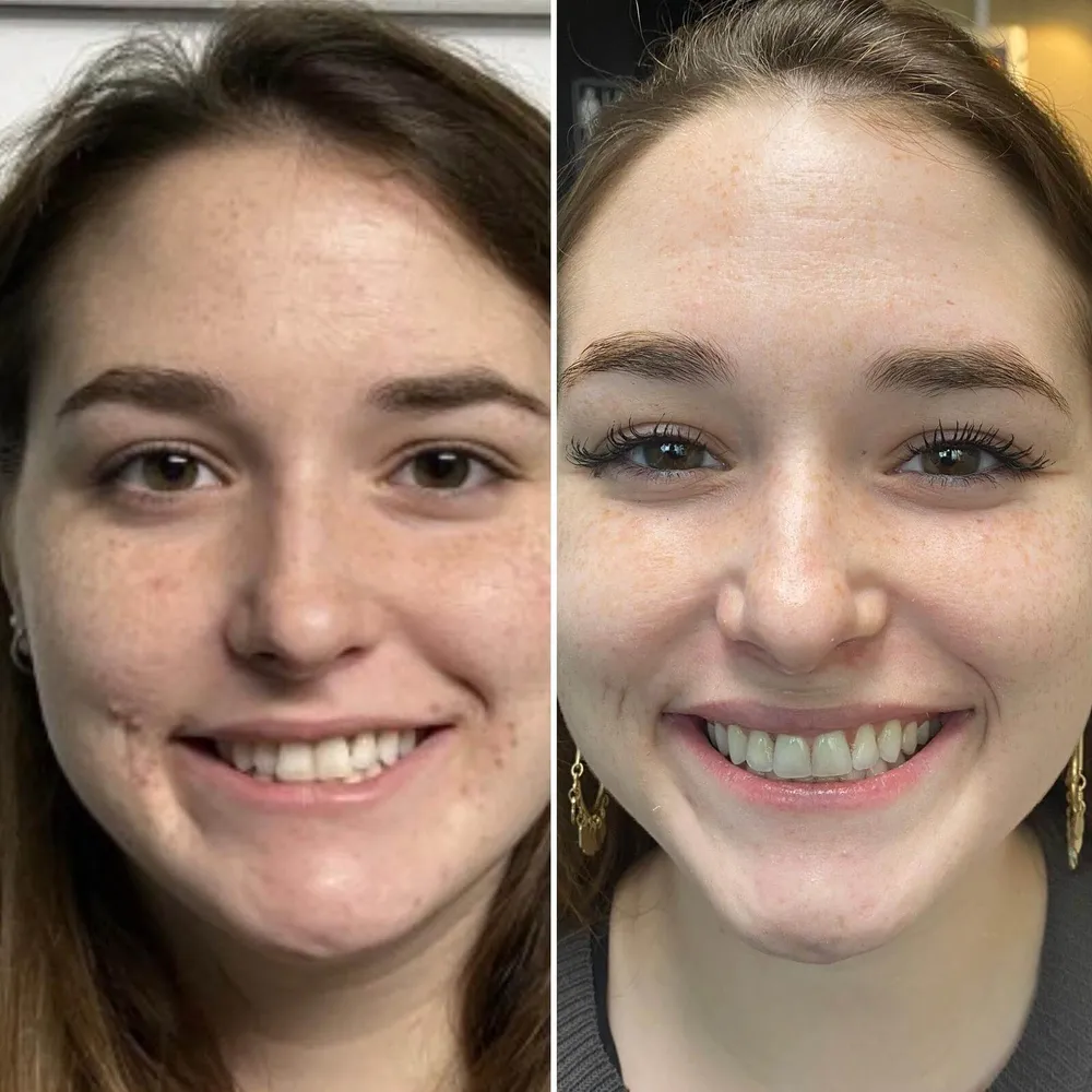 Invisalign clear aligner result