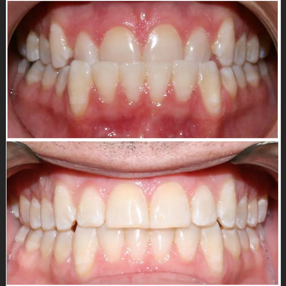 Straightened smile after Invisalign