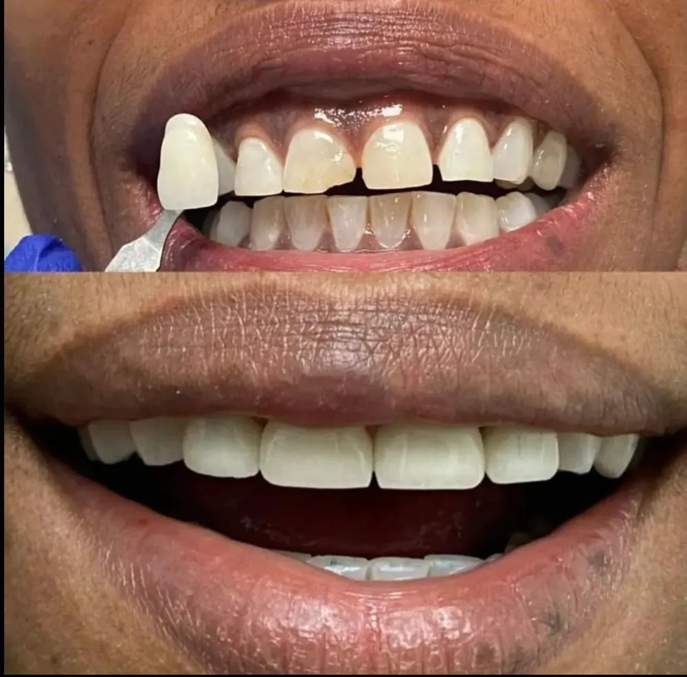 A bright, natural-looking porcelain veneer smile result