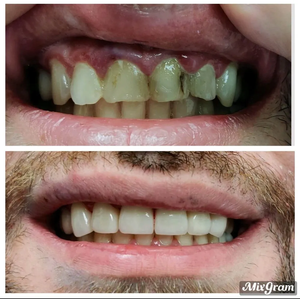 Veneer smile makeover result