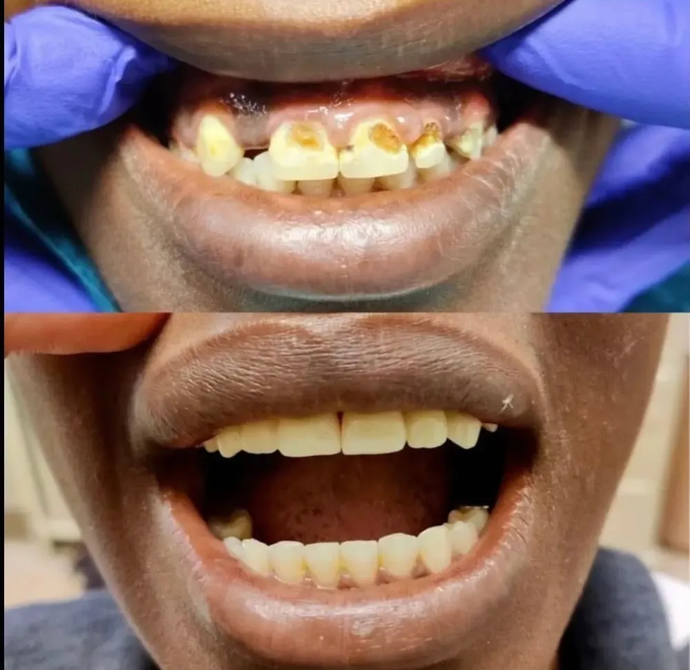 Veneers and crowns result