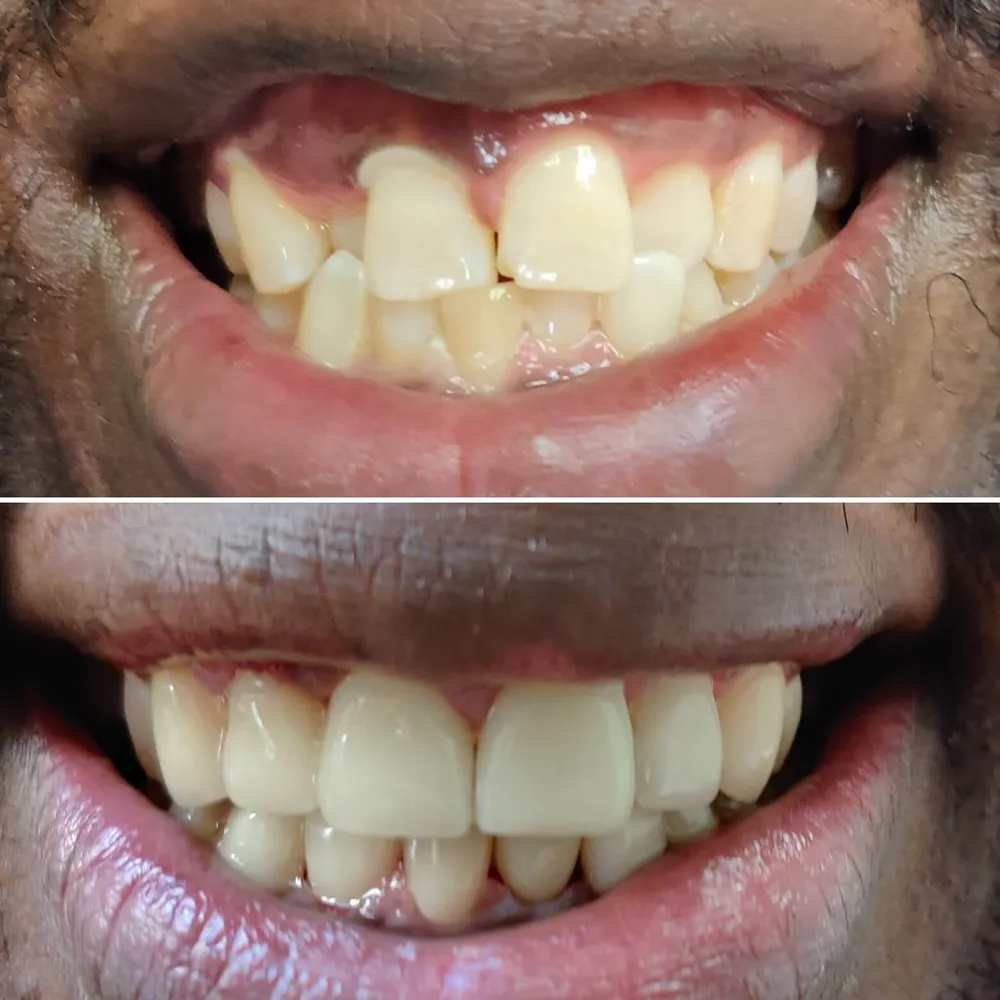 Cosmetic veneer result