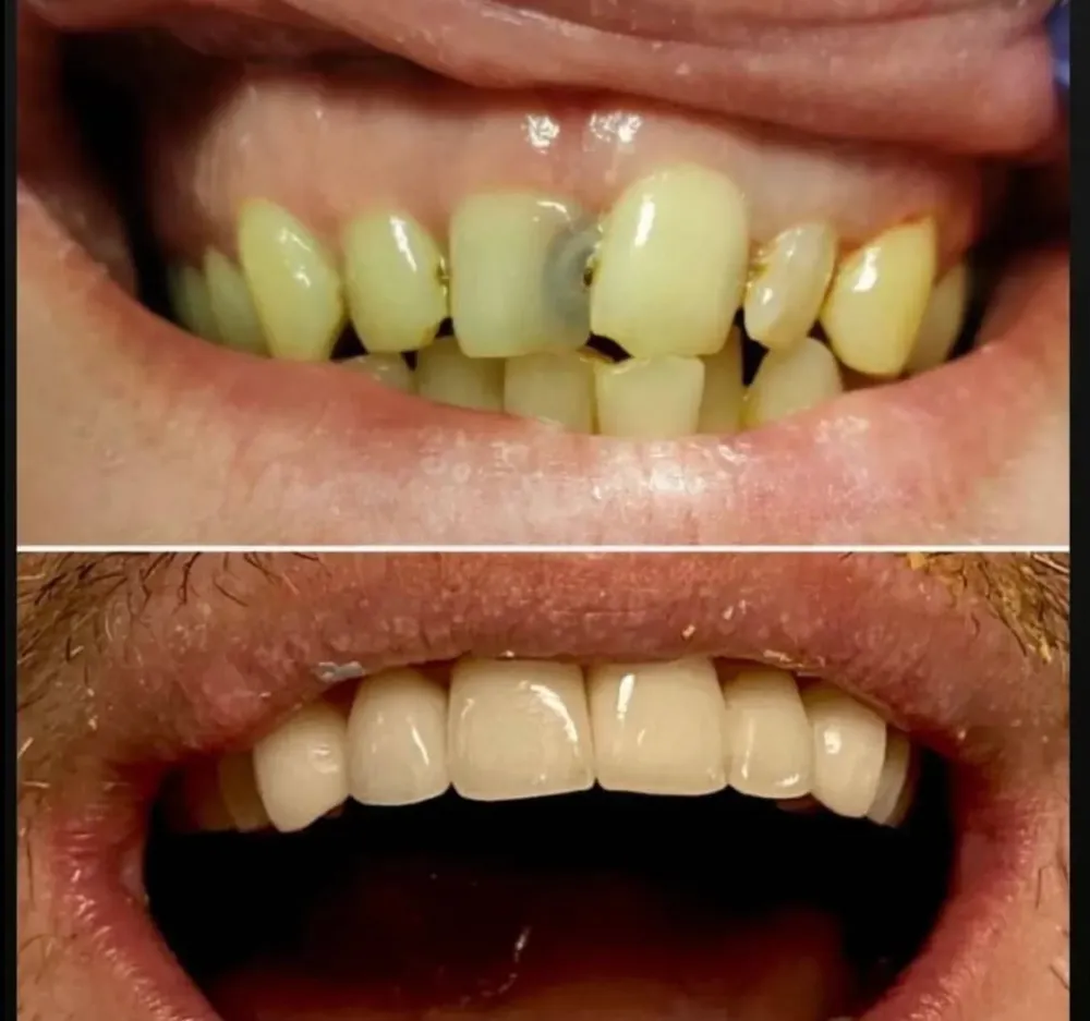 Veneers and crowns smile result