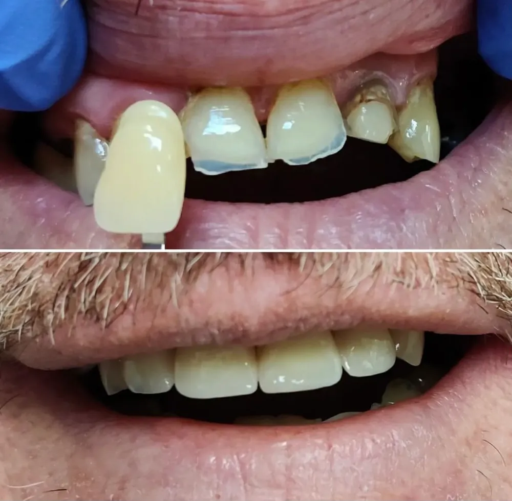 Porcelain veneer transformation